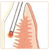 Laser Gum Treatment